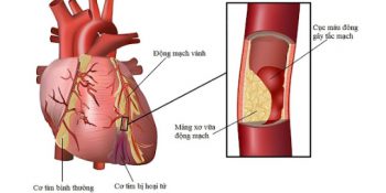 Cách Dùng Các Loại Thuốc Hạ Mỡ Máu Sao Cho Hiệu Quả Cập Nhật 12-2024