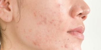 Sử Dụng Serum Trị Mụn Thâm Cho Da Có Tốt Không? Cập Nhật 08-2025